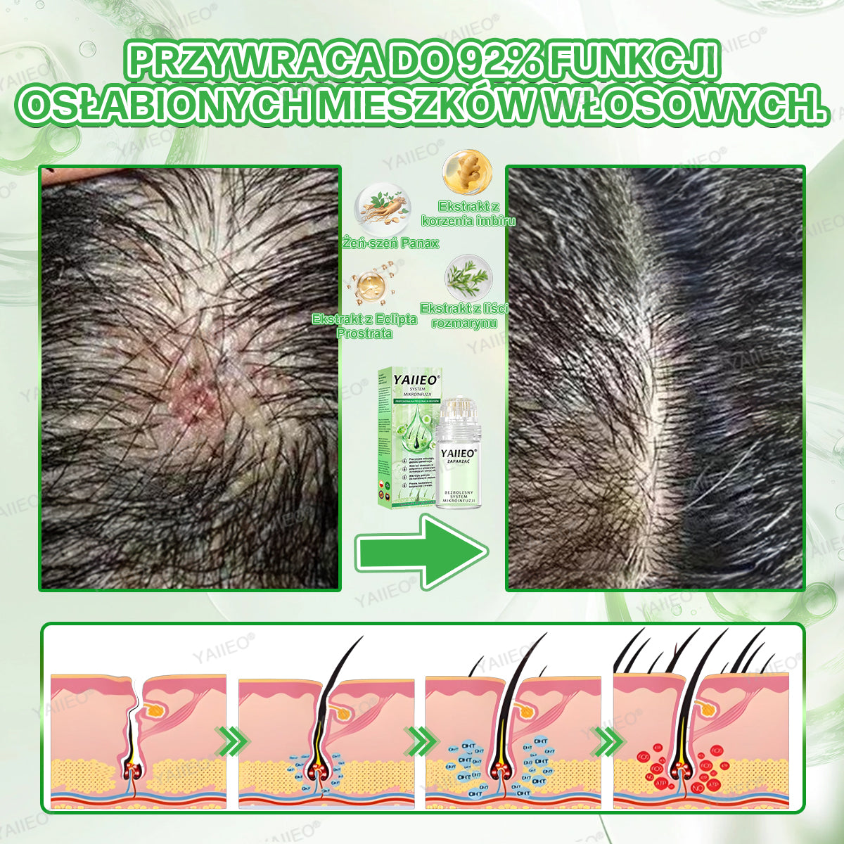 🍌 𝐘𝐀𝐈𝐈𝐄𝐎® Bezbolesny System Mikroinfuzji Głębokie blokowanie DHT, reaktywacja mieszków włosowych i widoczny wzrost włosów