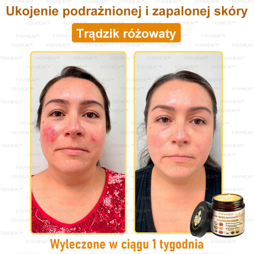 💎💎FOVHEAl™ Krem wielofunkcyjny z jadem pszczelim - Polecane przez dermatologów – Odpowiednie dla każdego wieku