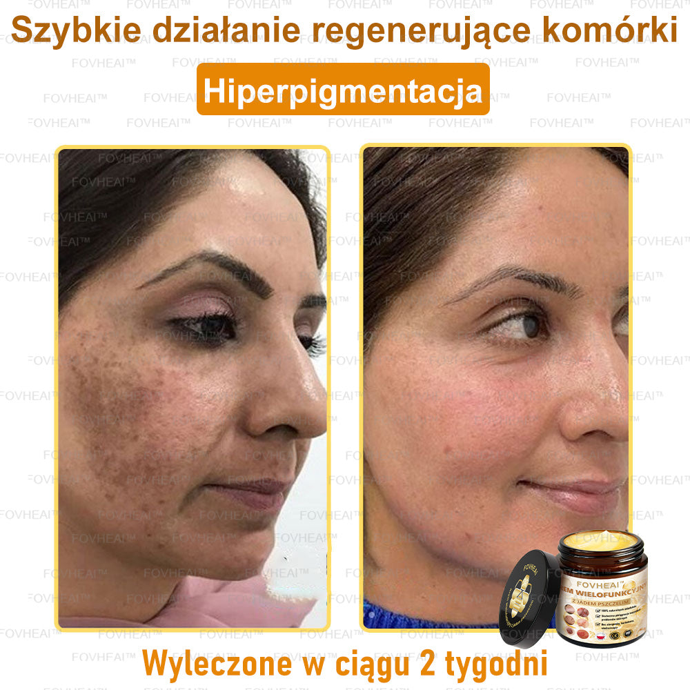 💎💎FOVHEAl™ Krem wielofunkcyjny z jadem pszczelim - Polecane przez dermatologów – Odpowiednie dla każdego wieku